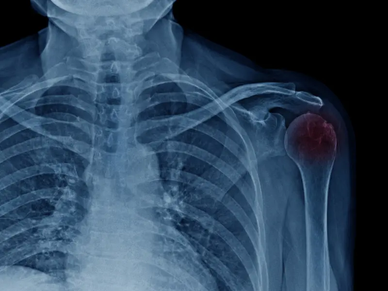 osteoartritis acromioclavicular